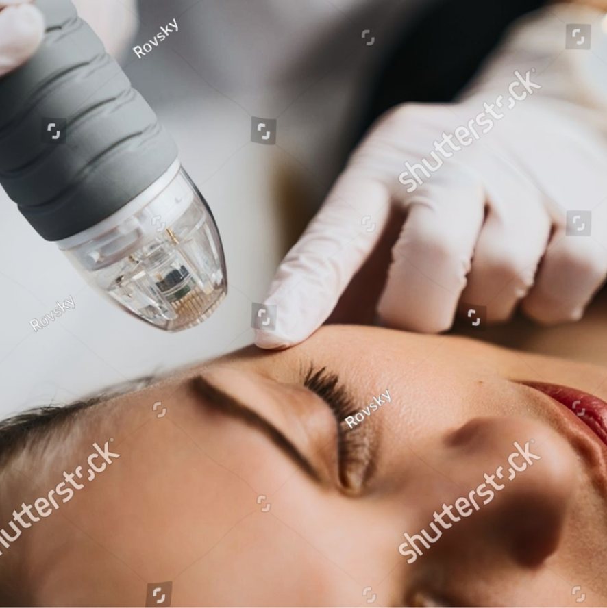 Laser treatment on the face