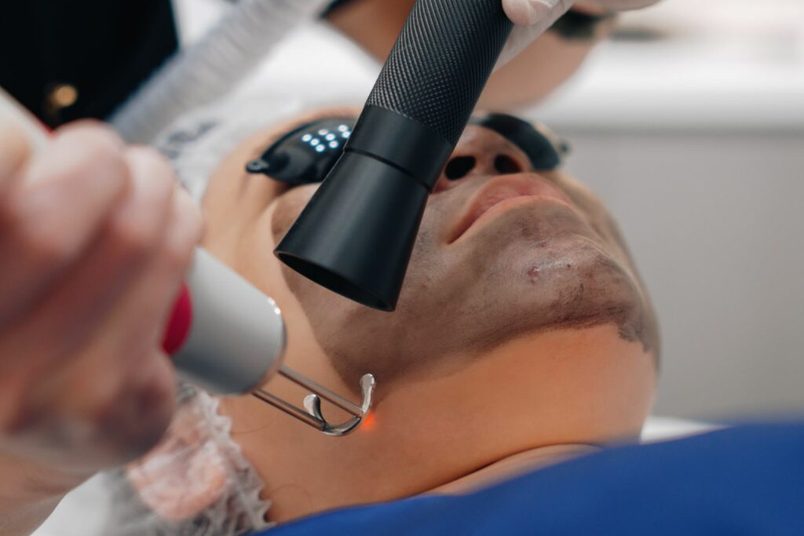Carbon laser peel treatment