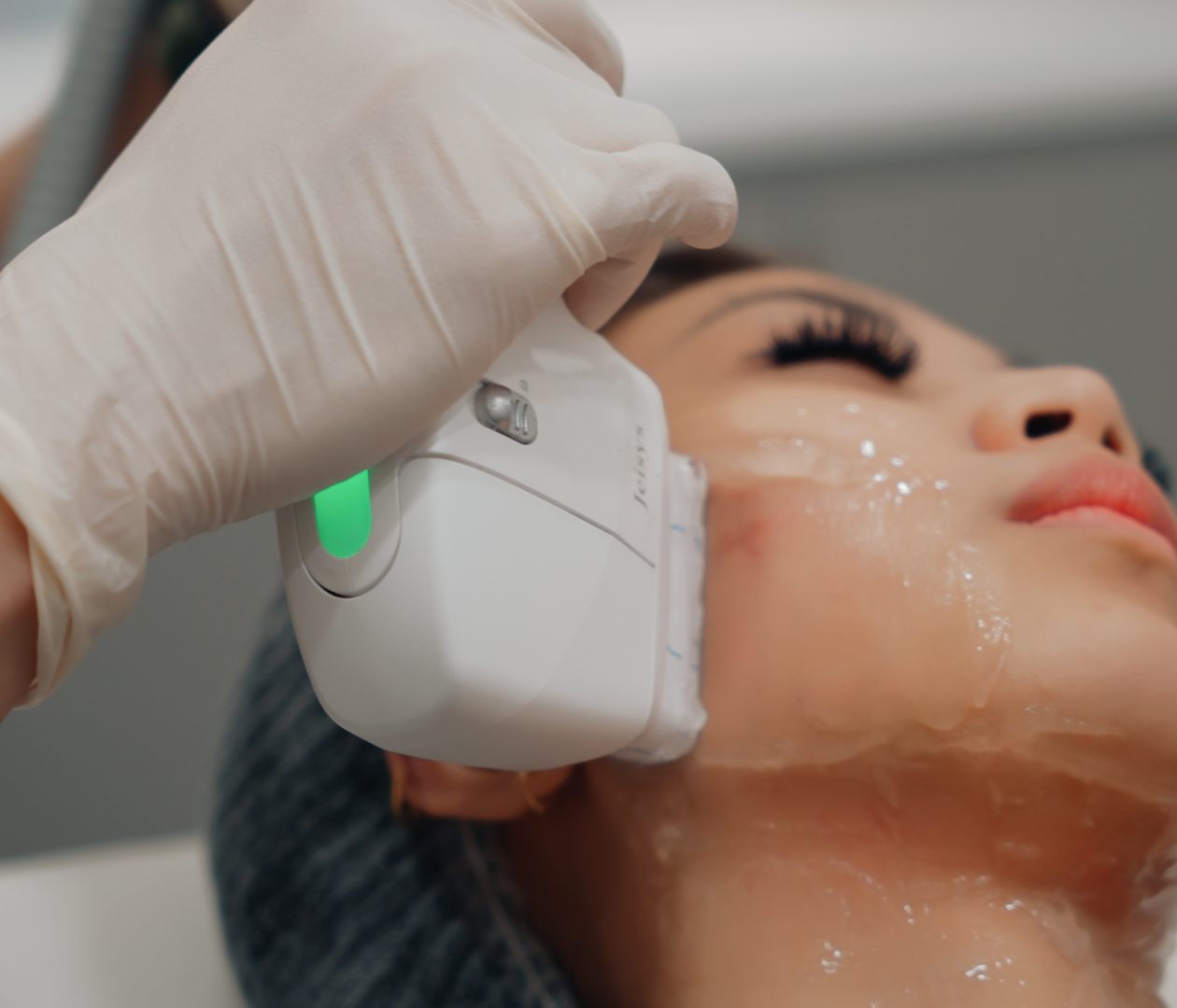 HIFU treatment on the jawline