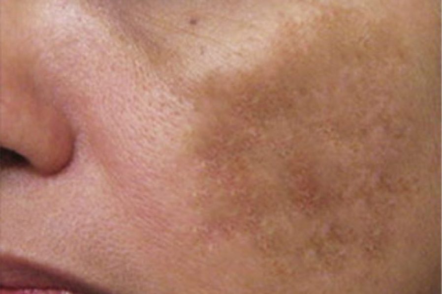 Pigmentation on the cheek