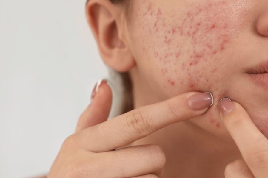 Acne and acne scars