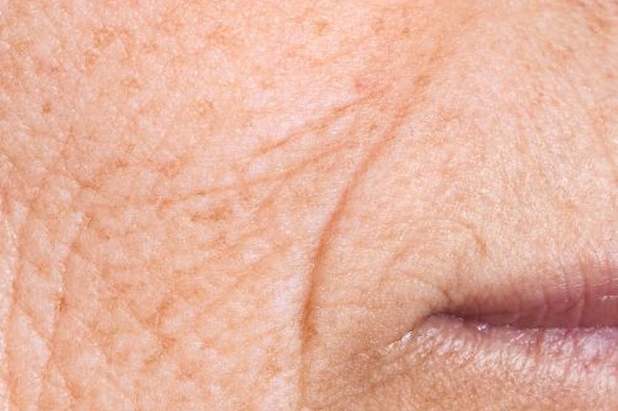 Wrinkles around the mouth