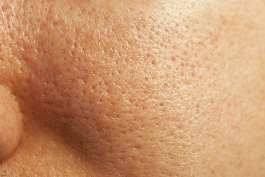 Enlarged pores on the skin