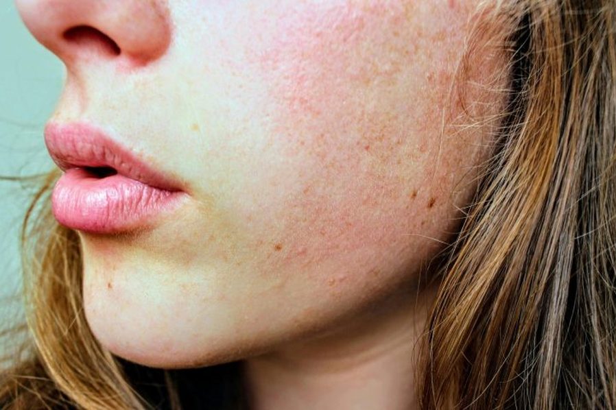 Dehydrated, reddened skin