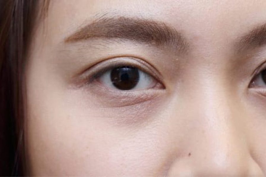 Dark circles under the eyes