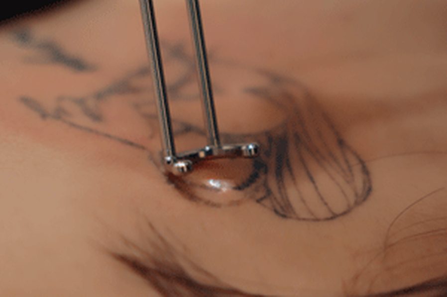 Laser tattoo removal