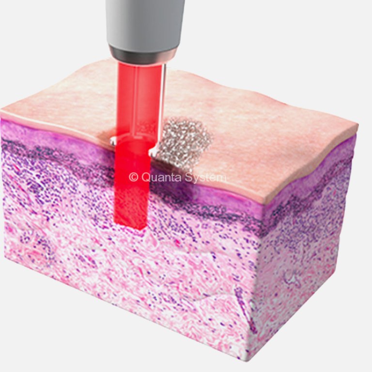 Laser energy shattering melanin in a skin cross-section