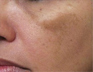 Darkening spots on the cheek