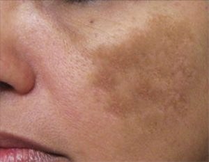 Larger dark spots on the cheek