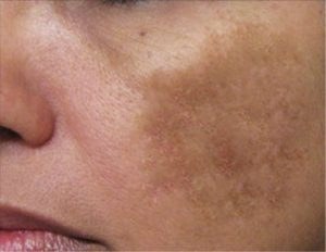 Dark spots spreading across the cheek