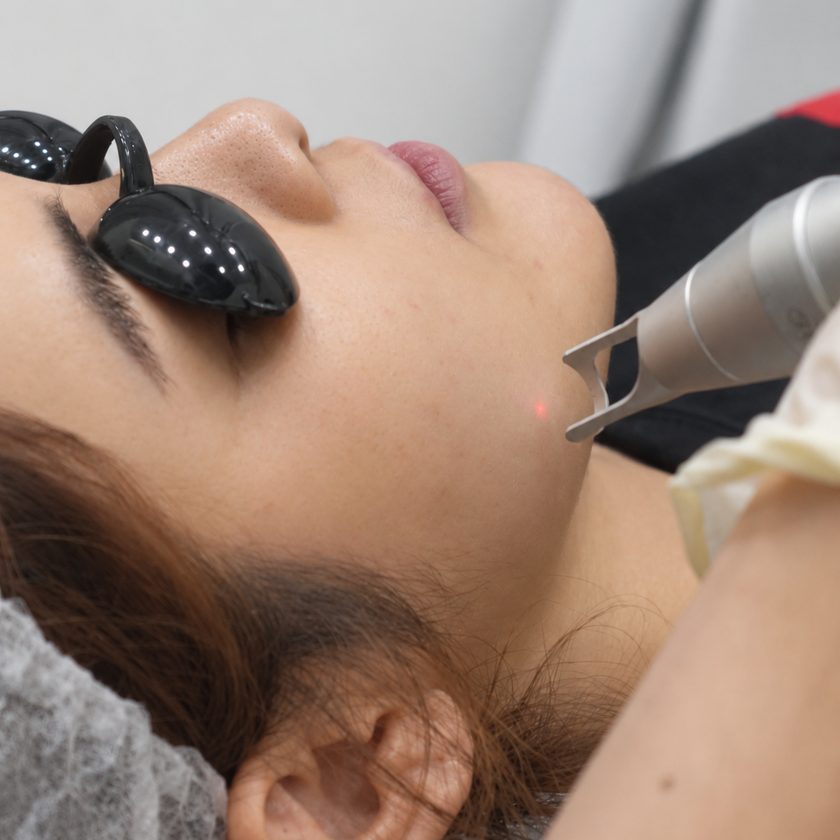 Discovery Pico laser treatment